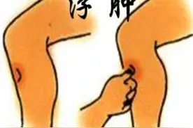 消水肿按摩5穴道，营养师快速消水肿食物名单大公开图片