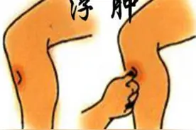 消水肿按摩5穴道，营养师快速消水肿食物名单大公开图片