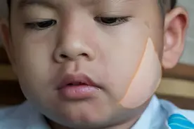 5月是流行性腮腺炎的高发季节，儿童易感发生猪头肿，家长要重视图片