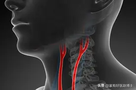 治疗颈动脉斑块，为何他汀是首选？他汀有没有起效，如何评估？图片