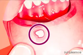 有一种痛，叫口腔溃疡：补充维C其实不管用，3个办法或更靠谱图片