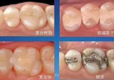 补牙用什么材料比较好？老牙医为你分析4种常见补牙材料利弊