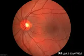 视力威胁：深入了解黄斑变性图片