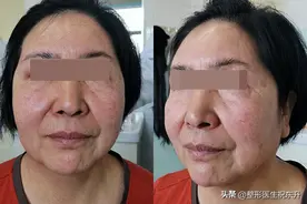 57岁不忍心脸垂，从山东来北京做了大拉皮，20天朋友“没敢认”图片