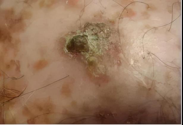 日光性角化发展