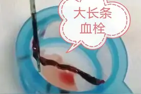 28岁，突发心梗，血栓已抽出，为啥还要做心脏支架？医生解释了图片