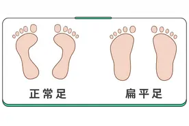 孩子扁平足，伴随这几种异常！有脊柱侧弯、驼背的风险图片