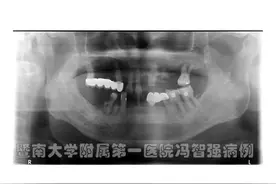 多病缠身的帕金森患者也能种牙？精准种植使八旬老人重获好牙图片