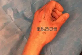 牙疼怎么办？别撑着！试试这一组穴位，让你立刻止痛图片