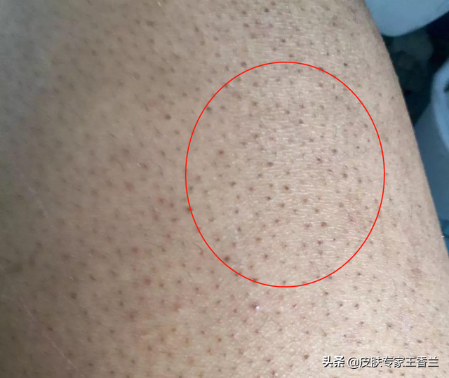 去医院皮肤病看鸡皮