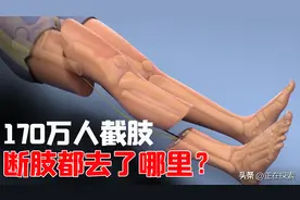 我国有170万人截肢，他们的断肢都怎么处理？答案或超乎你的想象图片