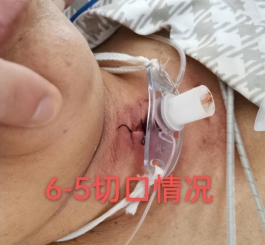 手术后刀口发红怎么办