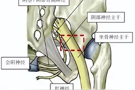 姿势解密技术治疗持续性生殖器官兴奋紊乱/生殖器官-骨盆感觉障碍综合征一例并文献复习图片