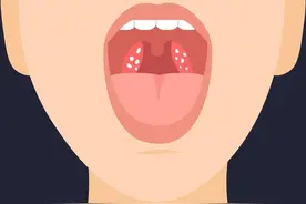 总发炎的“扁桃体”能不能切？医生总结几个标准图片