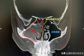 鼻中隔偏曲矫正三大误解：自我矫正、徒手正骨和吃药改善图片