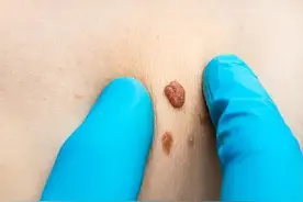 女生检查HPV要做哪些项目？男性也可以查吗？图片