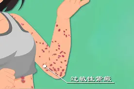 什么是过敏性紫癜？图片
