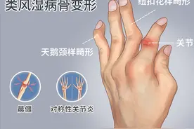手指关节疼痛、肿胀、变形？记住这3点，恢复日常功能图片