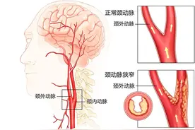 体检发现颈动脉斑块，要不要吃“他汀”？图片