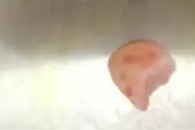 女子摔跤把上牙磕进上嘴唇，1个月后才发现：嘴唇肿了1个月一直以为是摔的，牙齿已被取出图片