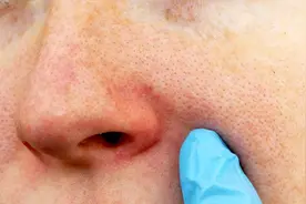 头发和脸部经常出油，或与4个因素有关，及时找出原因，或能缓解图片