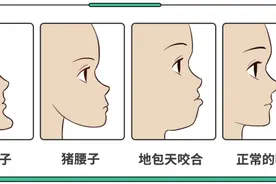 想趁放假给孩子矫正牙齿？弄懂这3个问题，你再行动！图片