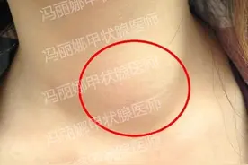 如果近期发现孩子脖子肿了，不要认为是孩子胖了，警惕甲状腺问题图片