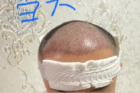 植发前必须知道的4件事，南京小伙分享植发经历图片