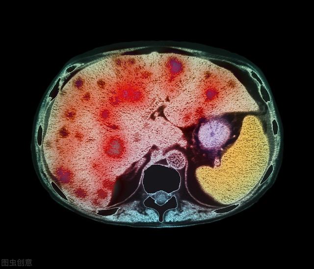 食欲不振、消瘦、肚子却莫名变大，发现肝腹水还能活多久？