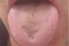 舌头有齿痕，又有裂纹，多是胃强脾弱，2味中药泡水喝健脾养胃阴图片