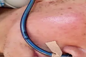 手术插管好难受，胃癌术后多久才能拔胃管和引流管？图片