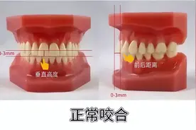 自测：你是深覆颌还是深覆盖？图片