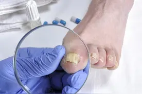 如何根治灰指甲？很多人都搞错了，光治指甲是治不好灰指甲的图片