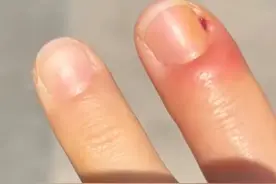 女子拔手指倒刺导致感染，整条手臂无法抬起，医生：只能拔掉指甲，严重可能引发骨髓炎，有截肢风险图片