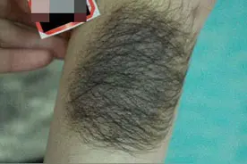 注意！这种黑色胎记有可能会癌变！图片