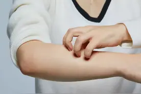 荨麻疹，病因很简单，治疗就更简单了！图片