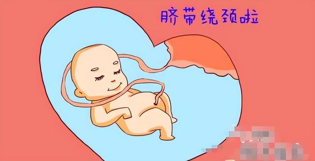 胎儿脐带绕颈三周怎么办