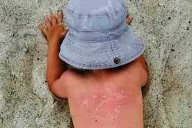 红斑、脱皮......郑州7岁男孩玩水后被晒伤！医生提醒：水中的紫外线剂量更大图片