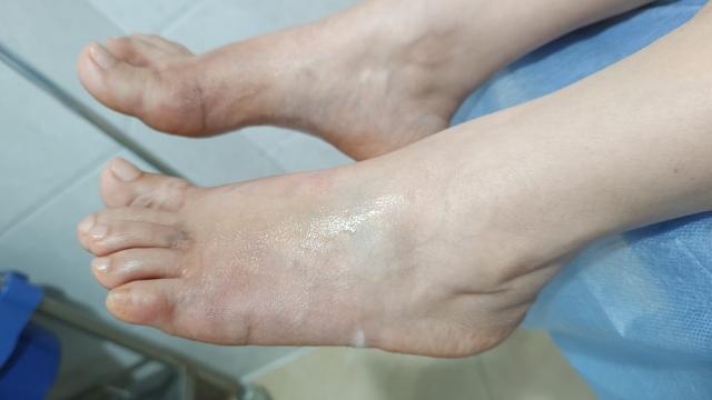 脚肥如何做窄?听大脚骨李医生说