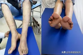 30岁女子双腿受凉变青紫 反复十年才知不是“湿疹”图片