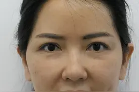 40岁中年女性为美奔赴北京，全脸整形90天后，颜值翻倍变“姐姐”图片