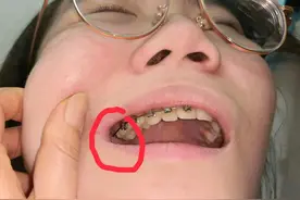 为什么孩子纠正牙齿戴的钢丝牙套，上面的铁扣总掉。图片