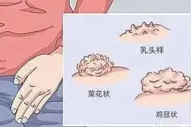 尖锐湿疣治愈后就自带抗体终身免疫吗？图片