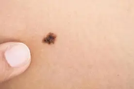 孩子身上的痣：解读福气的标志图片