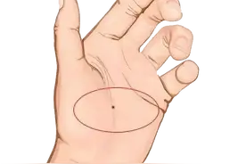 长在这些部位的痣，不痛不痒，却极有可能癌变图片