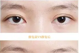 什么是双眼皮修复图片