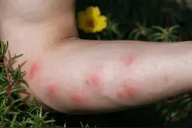 秋季是过敏性皮肤病多发的季节，吉大一院皮肤科专家提醒：换季衣服最好洗了再穿图片