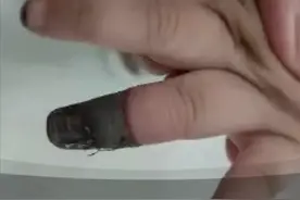 孩子磕碰划伤怎么办？儿科医生：这样处理最好图片