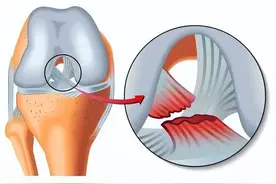 膝关节韧带损伤的症状和治疗方法图片