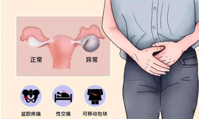 什么是巧克力囊肿?追剧的同时也涨知识啦!